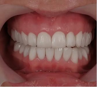 Smile Makeover - After