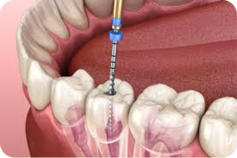 Root Canal Treatment